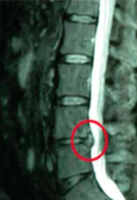 Medical spinal imaging scan with red circle highlighting area of interest on vertebral column