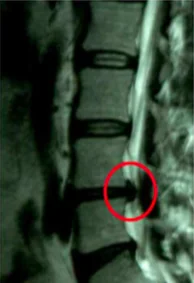 Spinal X-ray showing vertebrae with red circle highlighting a specific area of interest